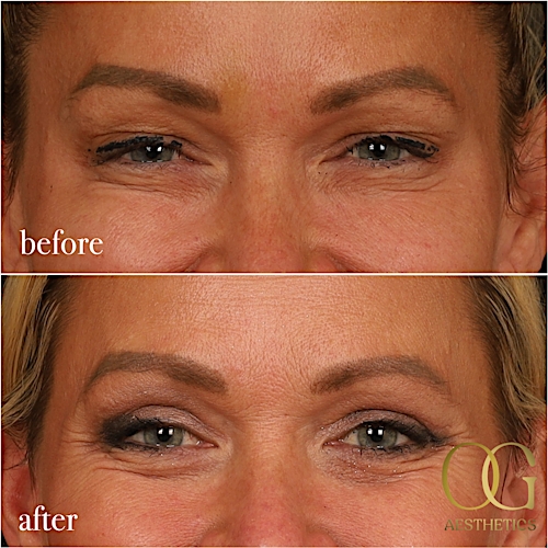 Blepharoplasty Before & After Gallery - Patient 242962 - Image 10