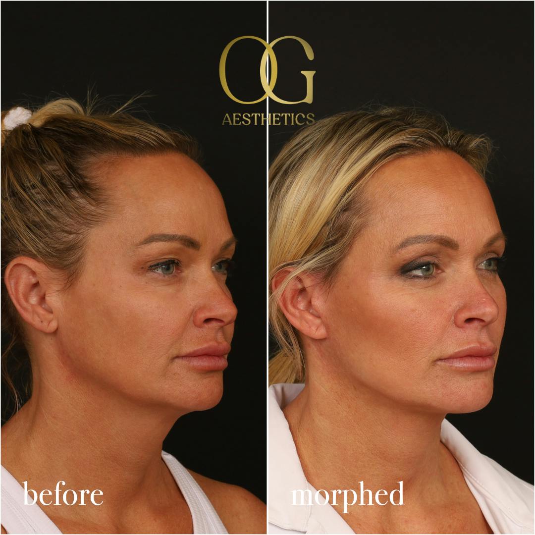 Neck Lift Before & After Gallery - Patient 273065 - Image 7