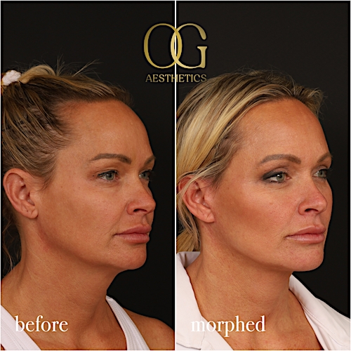 Neck Lift Before & After Gallery - Patient 273065 - Image 7