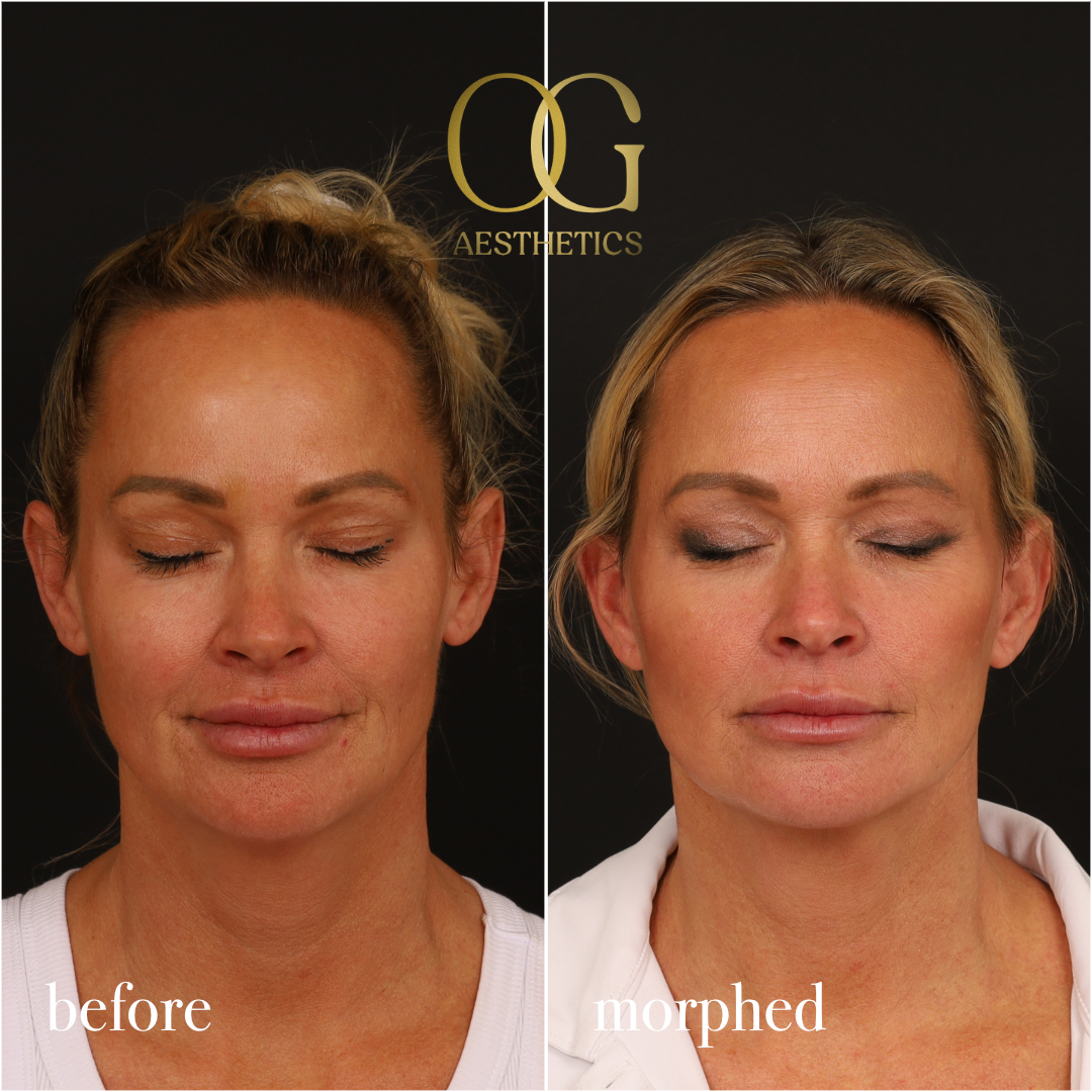 Neck Lift Before & After Gallery - Patient 273065 - Image 3