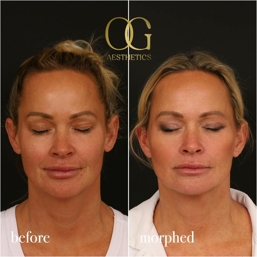 Neck Lift Before & After Gallery - Patient 273065 - Image 3