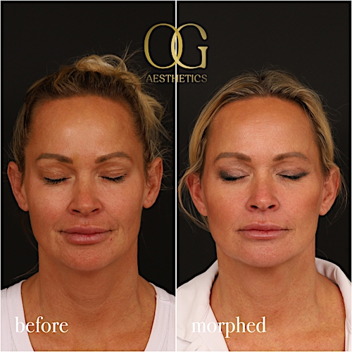 Neck Lift Before & After Gallery - Patient 273065 - Image 3
