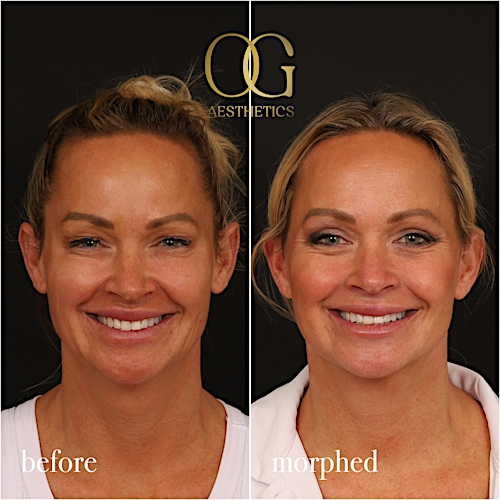 Neck Lift Before & After Gallery - Patient 273065 - Image 2