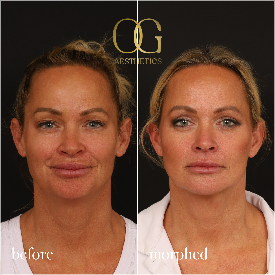 Neck Lift Before & After Gallery - Patient 273065 - Image 4