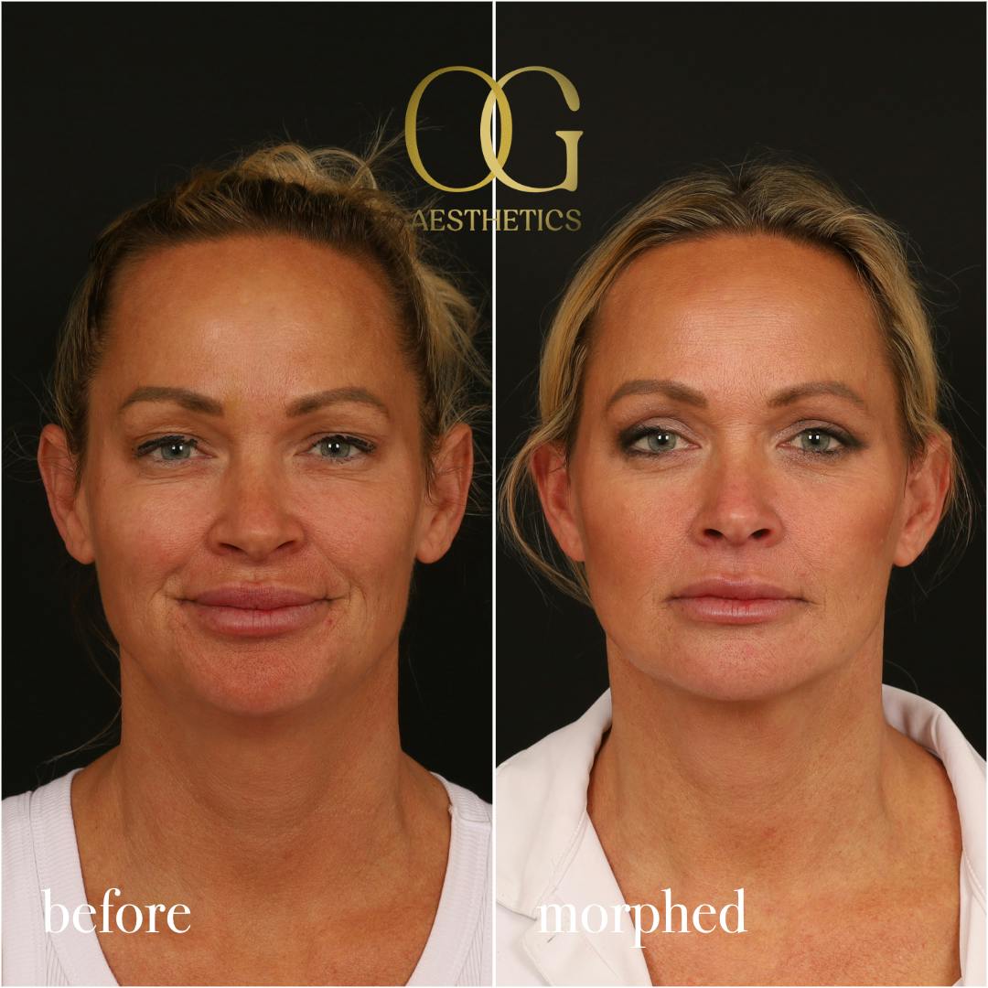 Neck Lift Before & After Gallery - Patient 273065 - Image 4