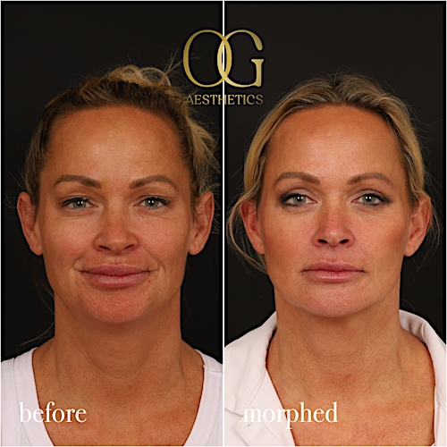 Neck Lift Before & After Gallery - Patient 273065 - Image 4