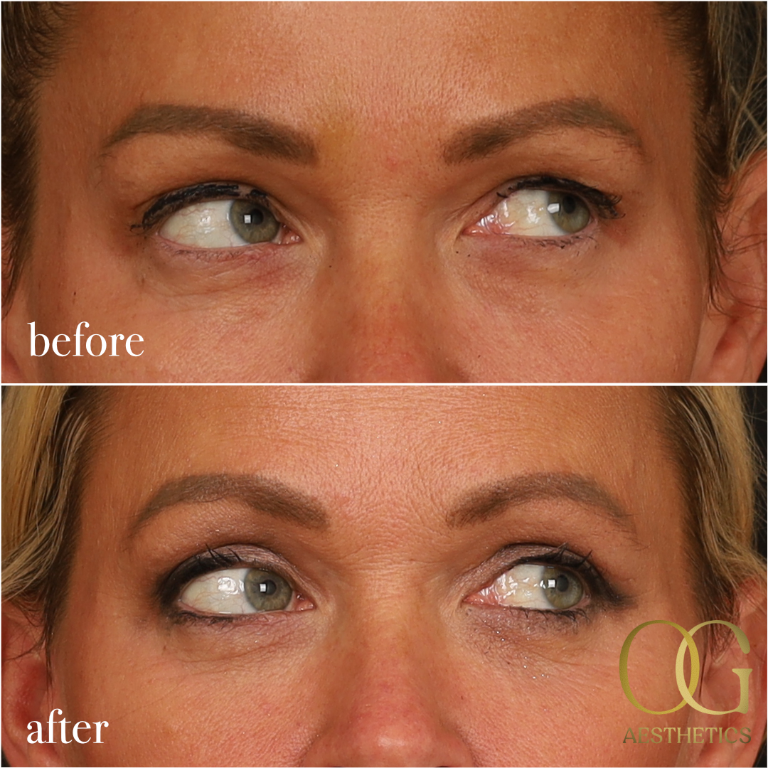 Blepharoplasty Before & After Gallery - Patient 242962 - Image 13