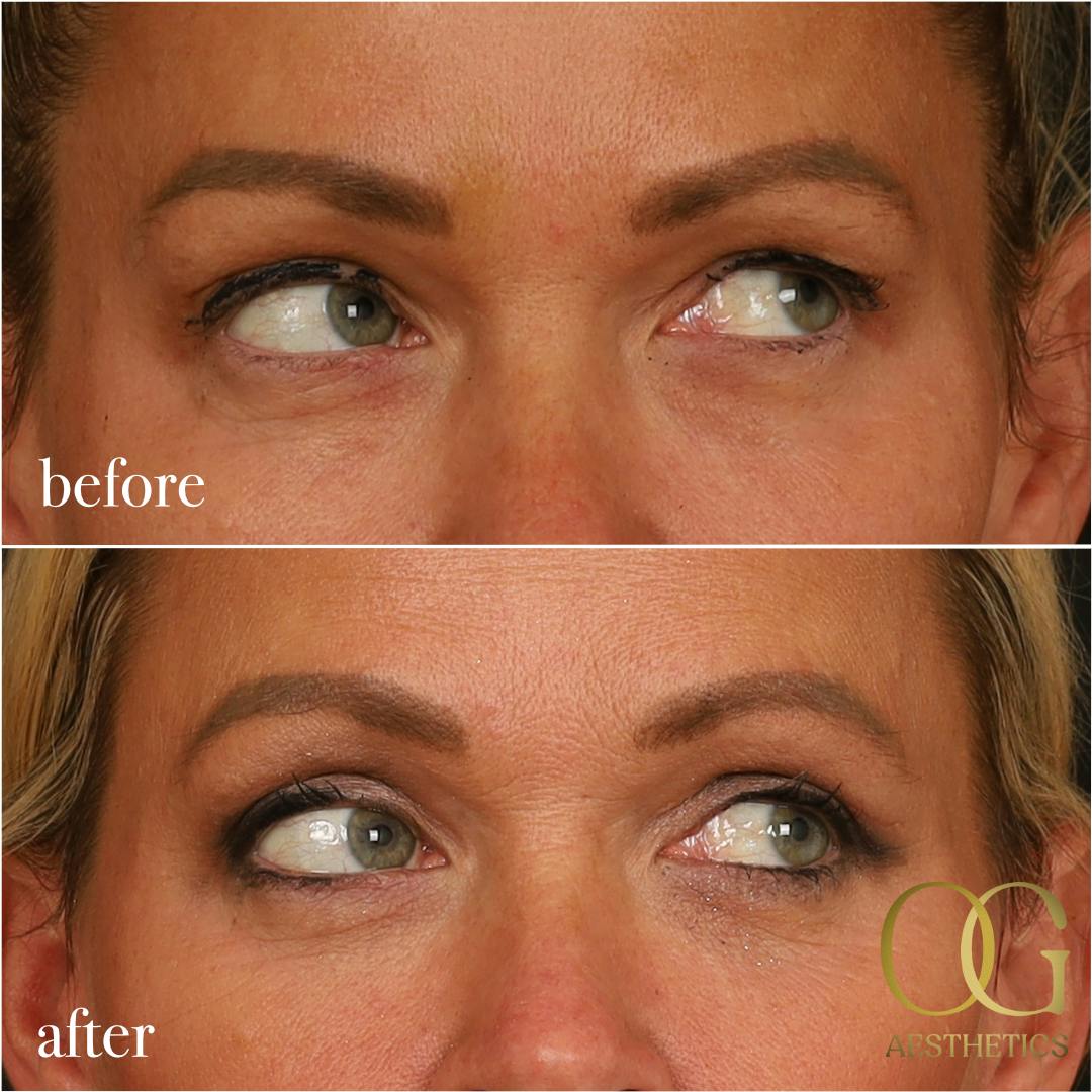 Blepharoplasty Before & After Gallery - Patient 242962 - Image 13