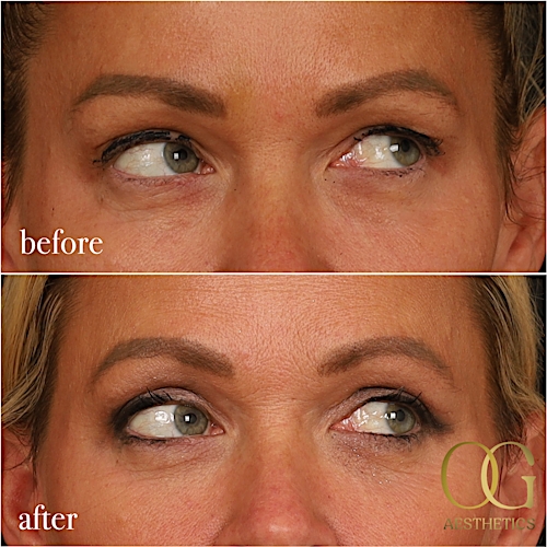 Blepharoplasty Before & After Gallery - Patient 242962 - Image 13