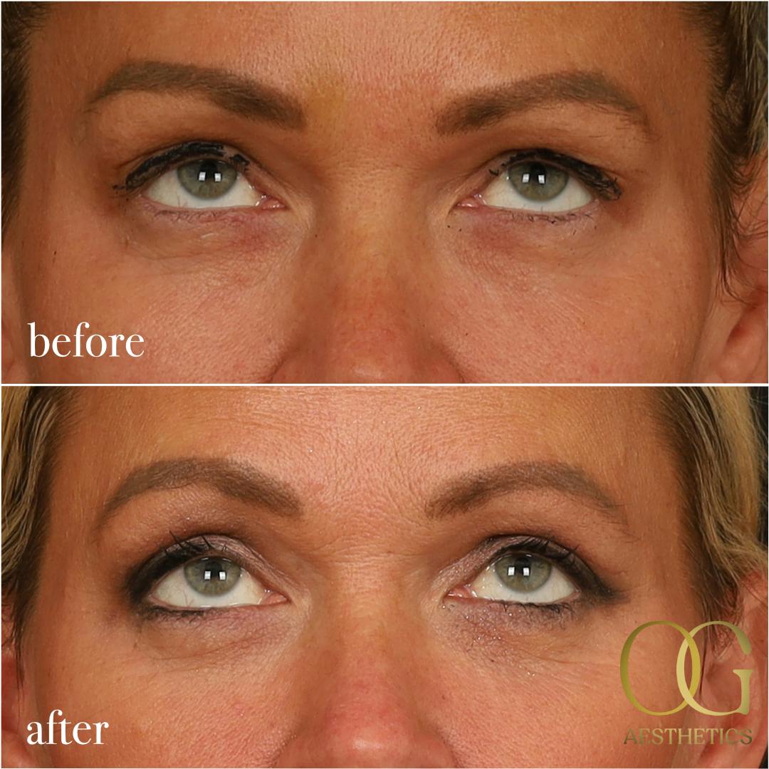 Blepharoplasty Before & After Gallery - Patient 242962 - Image 11