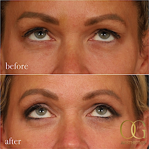Blepharoplasty Before & After Gallery - Patient 242962 - Image 11