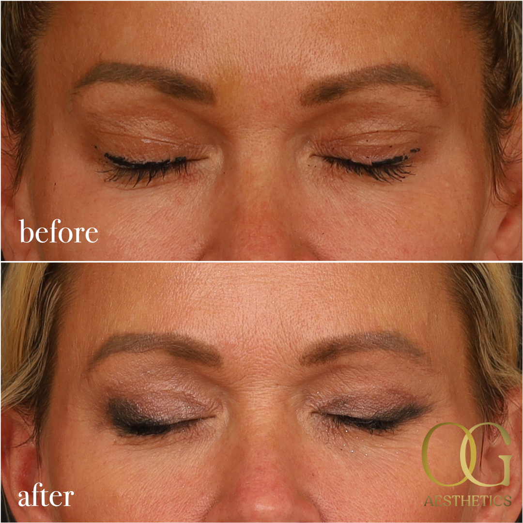 Blepharoplasty Before & After Gallery - Patient 242962 - Image 12