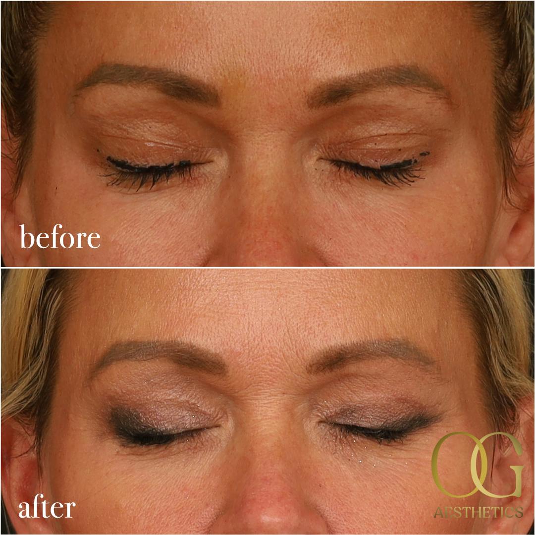 Blepharoplasty Before & After Gallery - Patient 242962 - Image 12