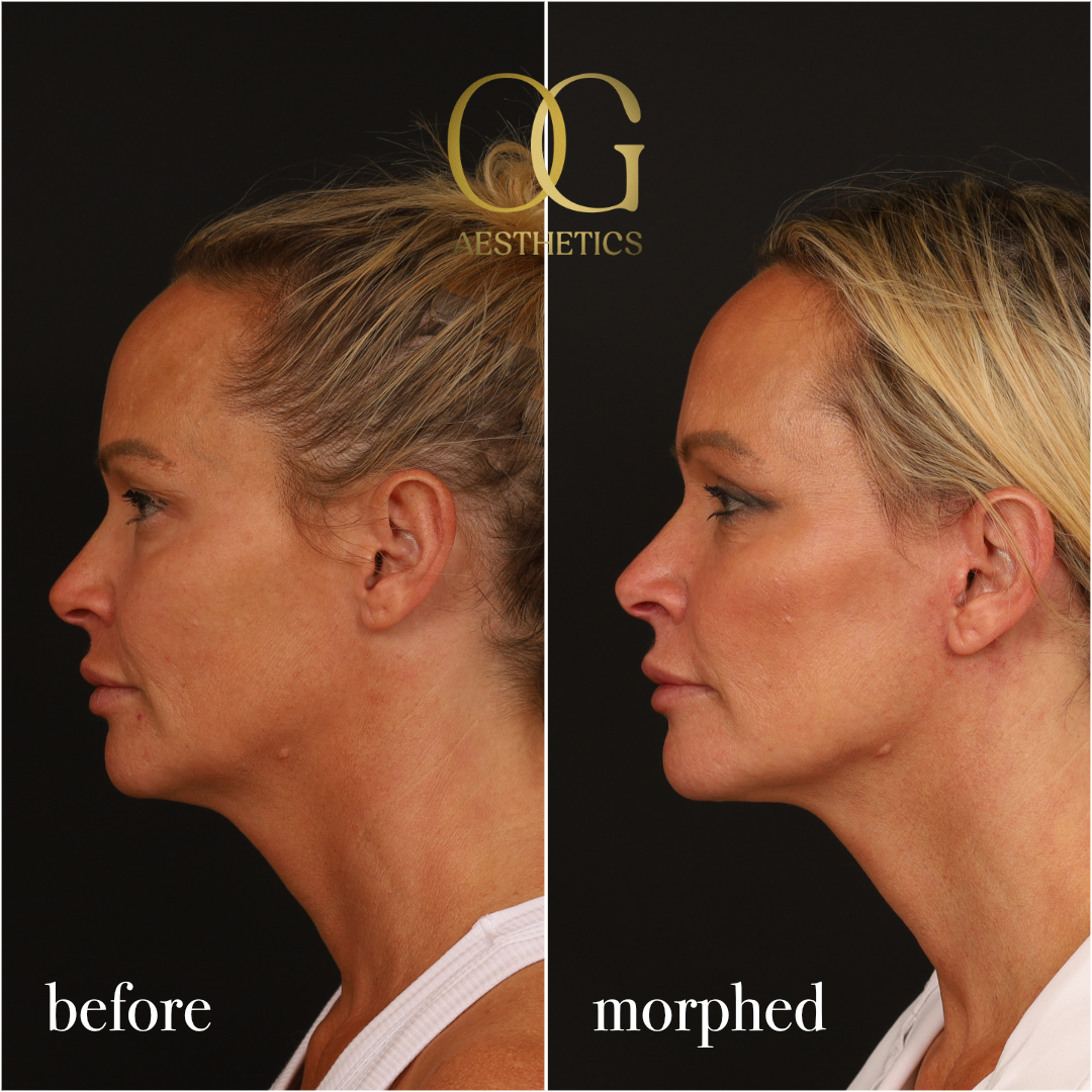 Neck Lift Before & After Gallery - Patient 273065 - Image 10