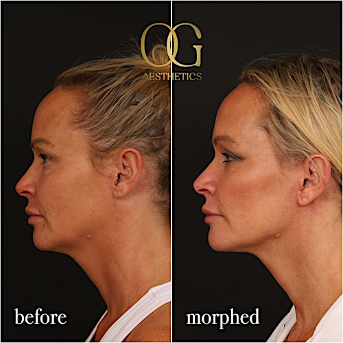 Neck Lift Before & After Gallery - Patient 273065 - Image 10