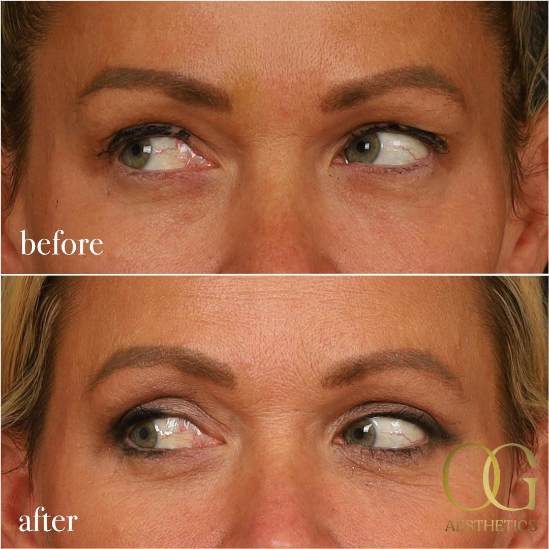 Blepharoplasty Before & After Gallery - Patient 242962 - Image 14