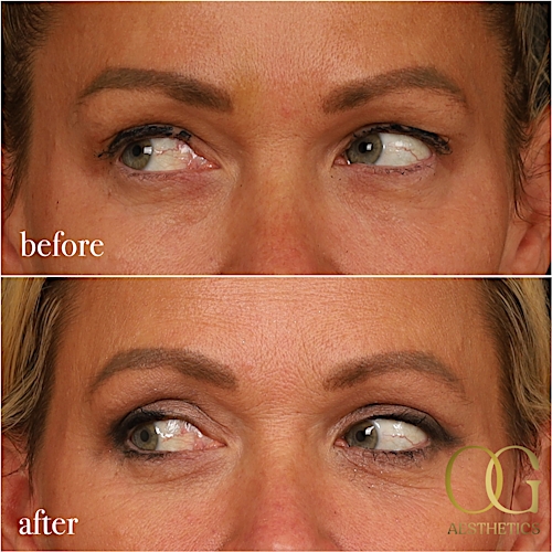 Blepharoplasty Before & After Gallery - Patient 242962 - Image 14