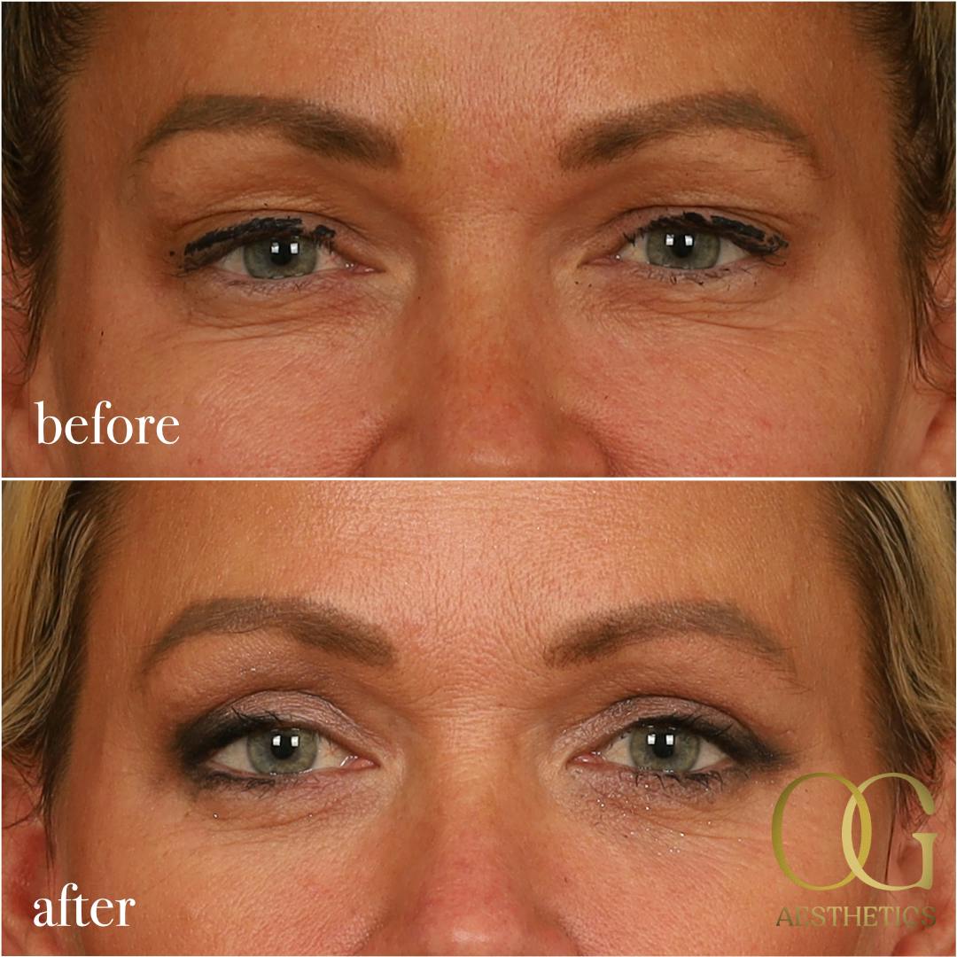 Blepharoplasty Before & After Gallery - Patient 242962 - Image 9
