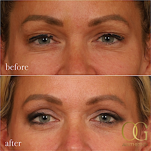 Blepharoplasty Before & After Gallery - Patient 242962 - Image 9