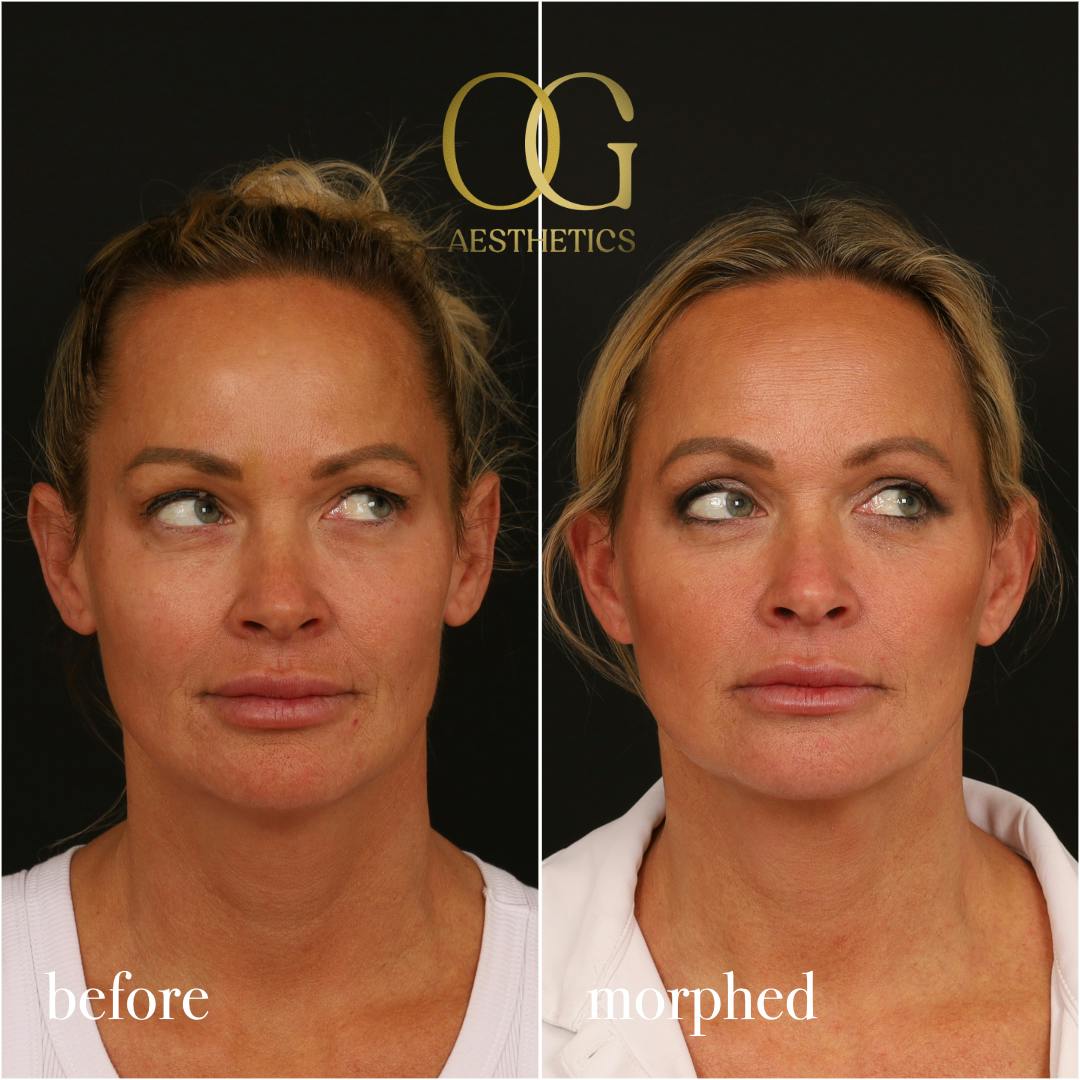 Neck Lift Before & After Gallery - Patient 273065 - Image 5