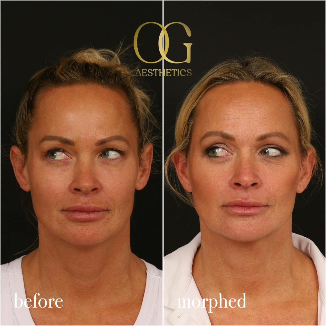 Neck Lift Before & After Gallery - Patient 273065 - Image 6