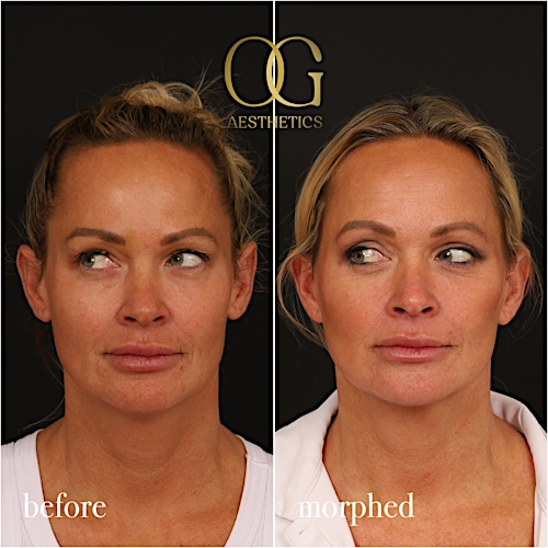 Neck Lift Before & After Gallery - Patient 273065 - Image 6