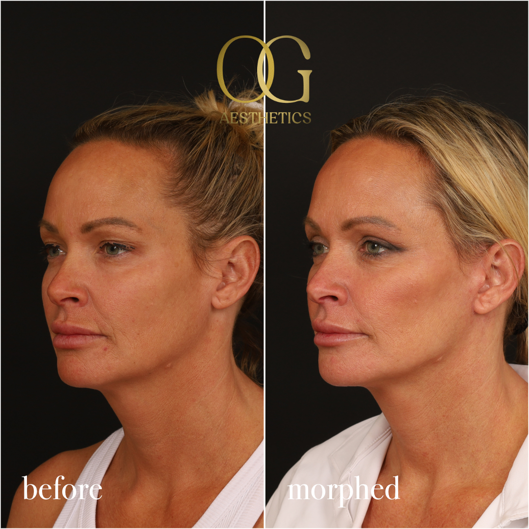 Neck Lift Before & After Gallery - Patient 273065 - Image 9