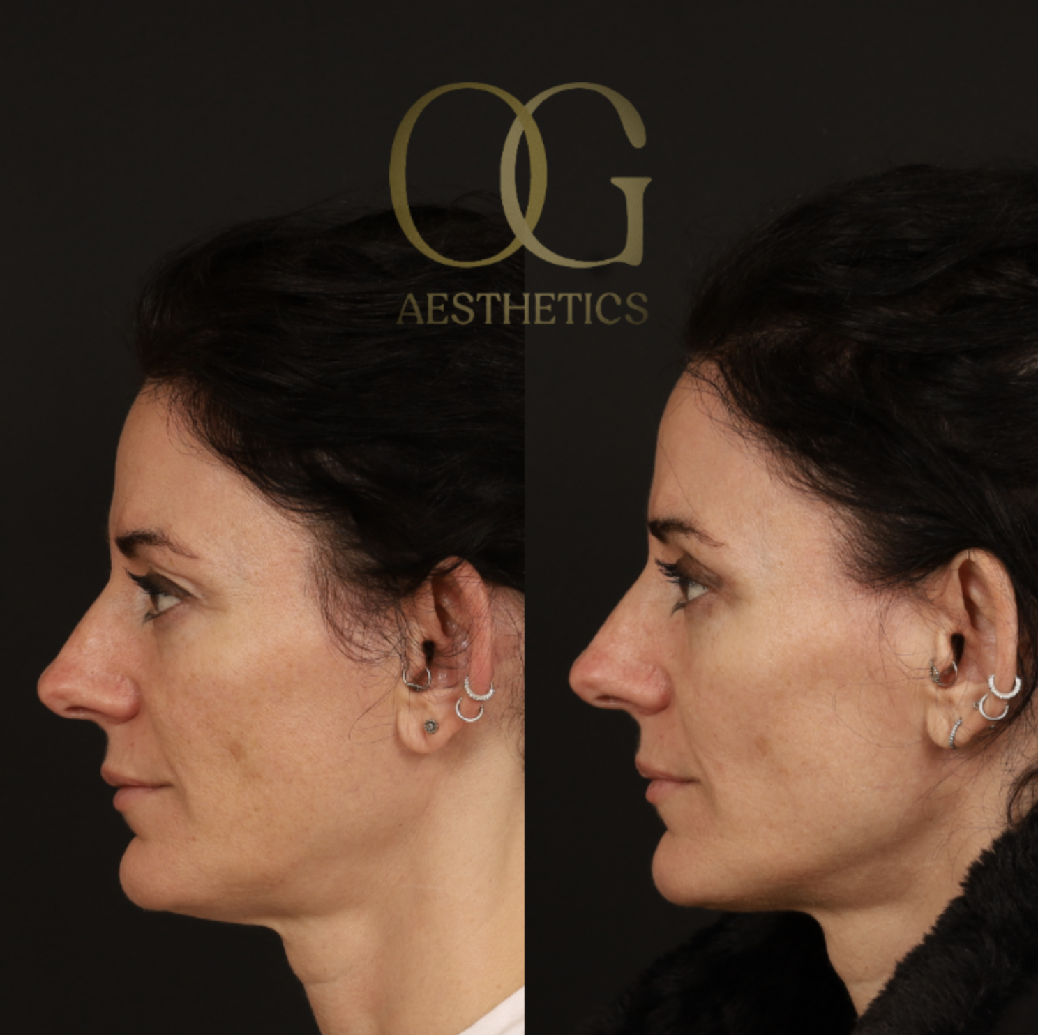 Blepharoplasty Before & After Gallery - Patient 380599 - Image 5