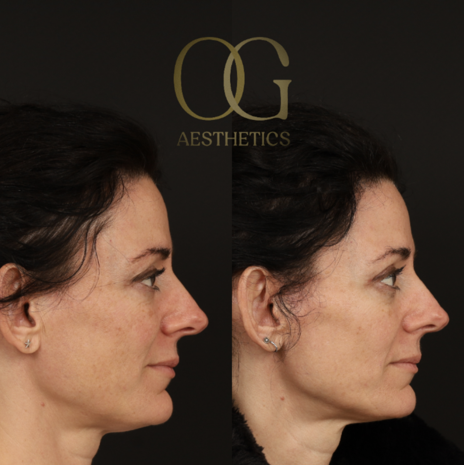 Blepharoplasty Before & After Gallery - Patient 380599 - Image 3
