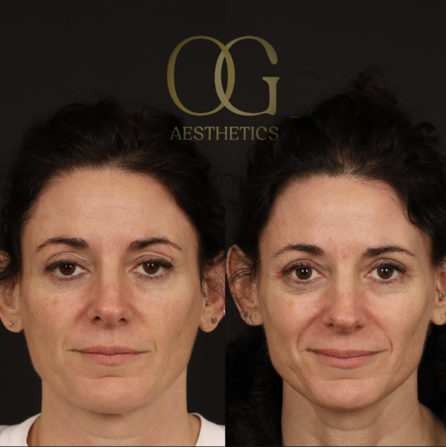 Blepharoplasty Before & After Gallery - Patient 380599 - Image 1