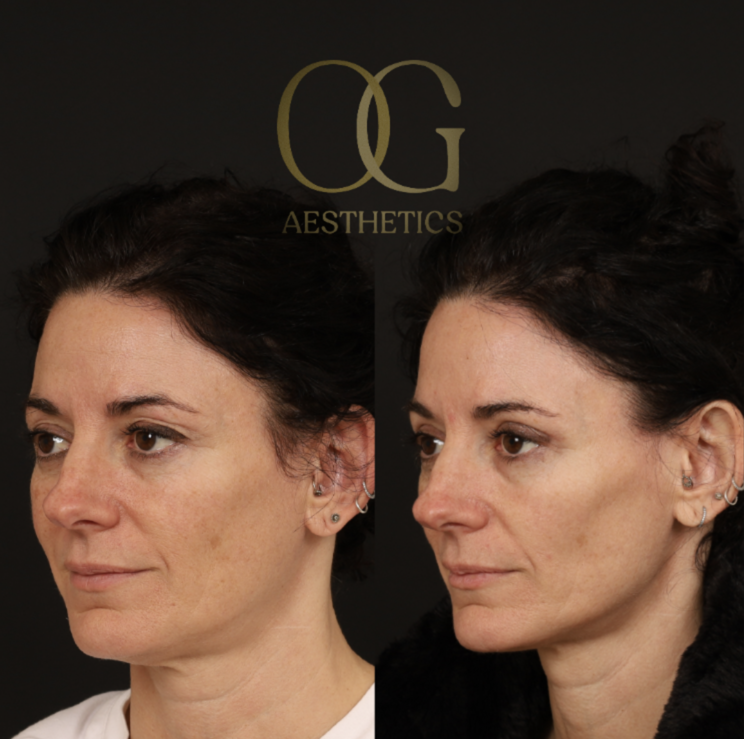 Blepharoplasty Before & After Gallery - Patient 380599 - Image 4