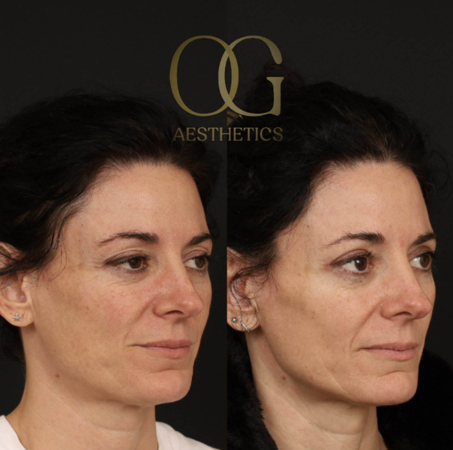 Blepharoplasty Before & After Gallery - Patient 380599 - Image 2