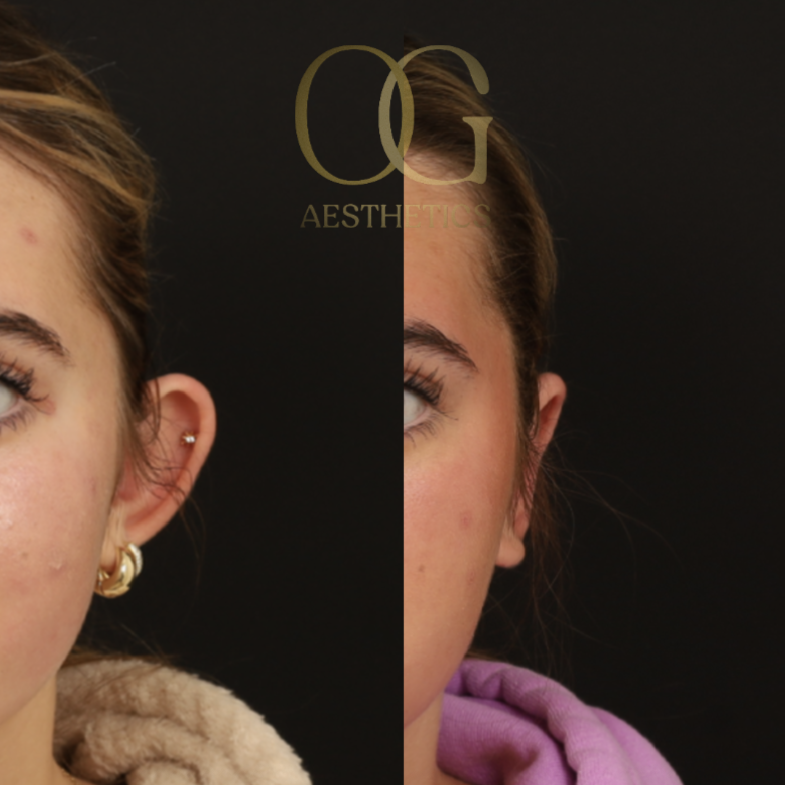 Otoplasty Before & After Gallery - Patient 112378 - Image 3
