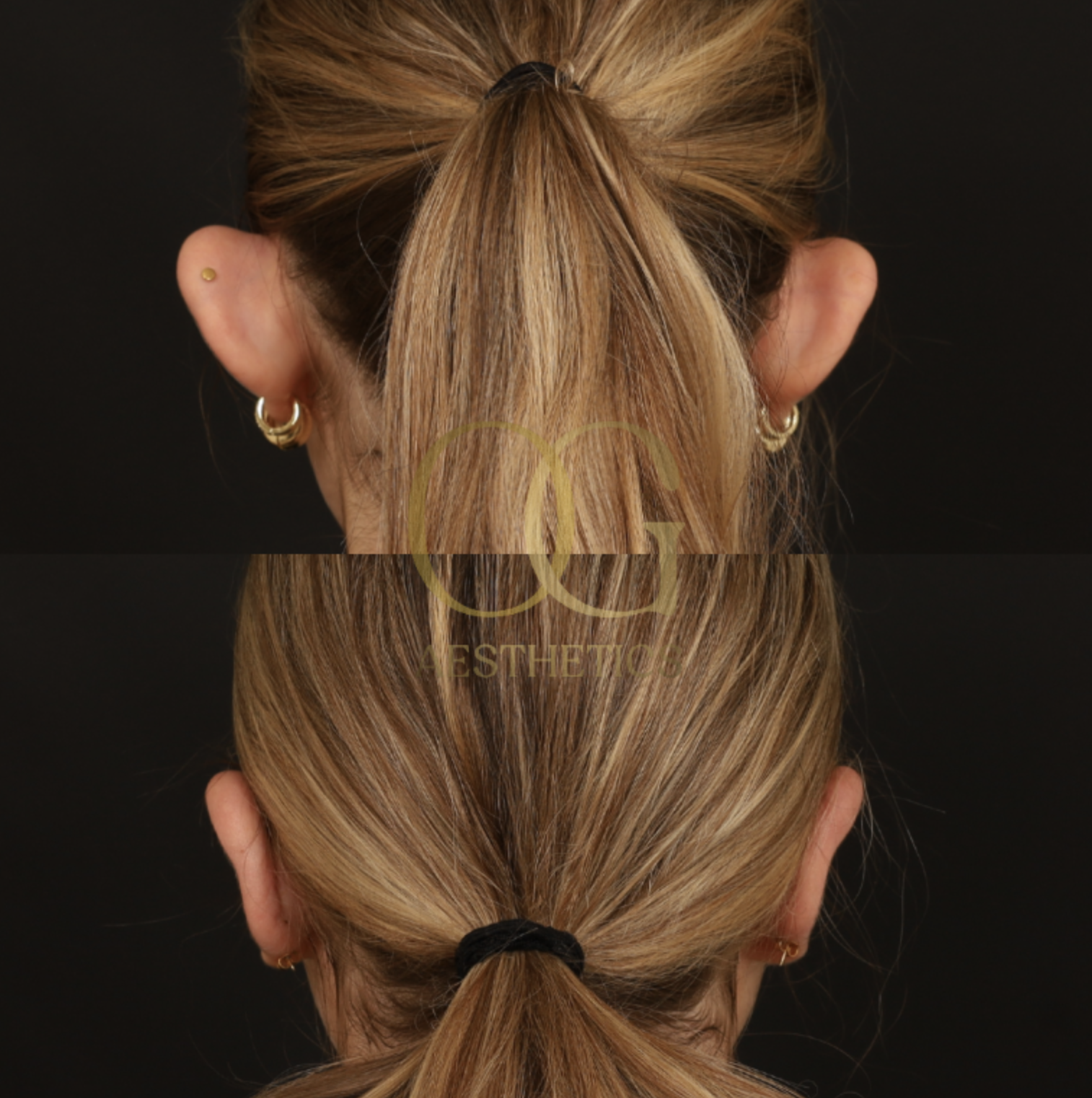 Otoplasty Before & After Gallery - Patient 112378 - Image 1