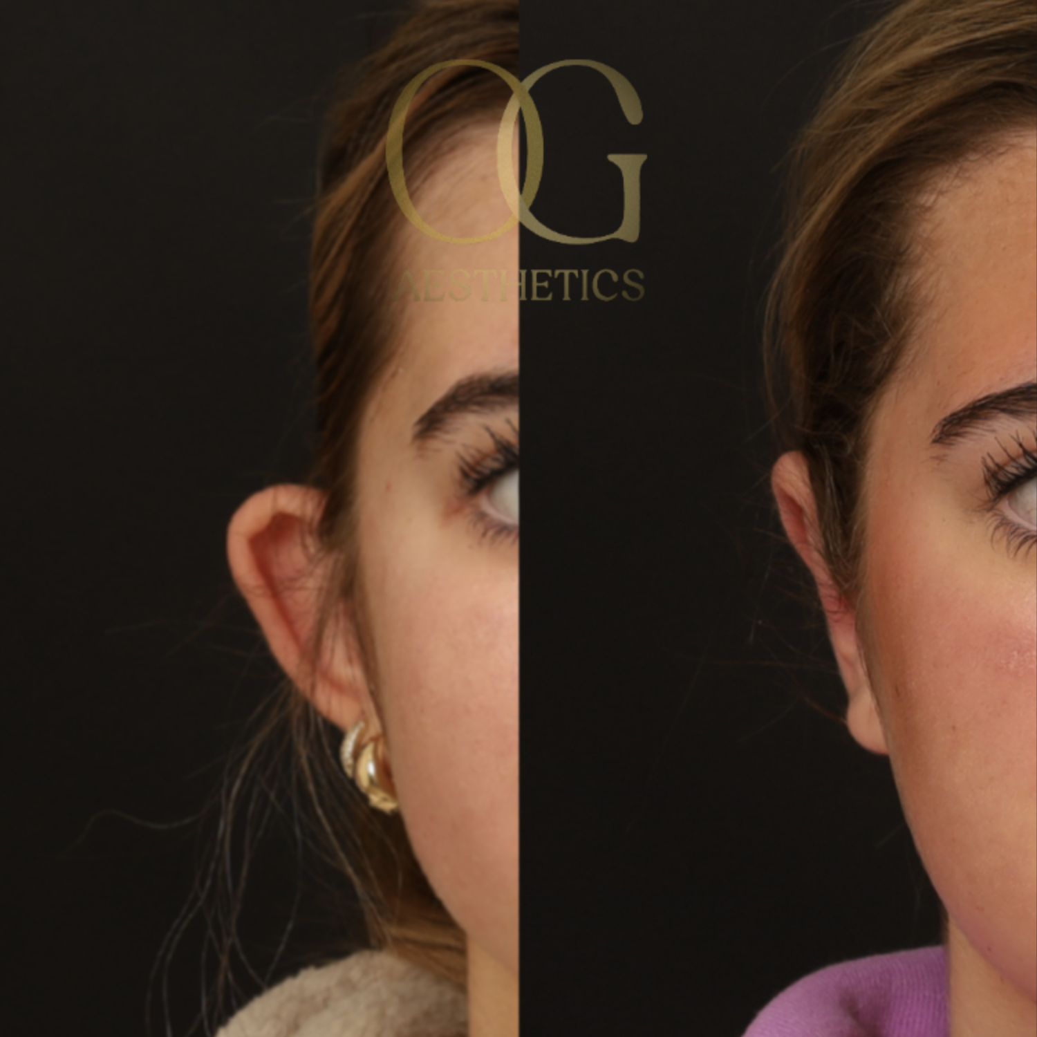 Otoplasty Before & After Gallery - Patient 112378 - Image 2