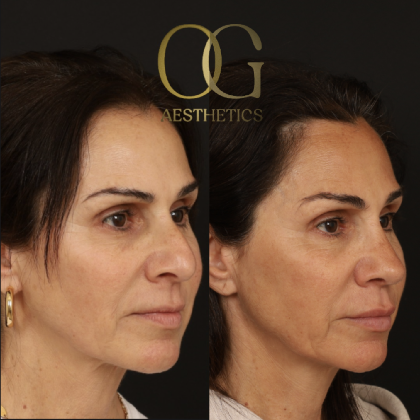 Rhinoplasty Before & After Gallery - Patient 395442 - Image 2
