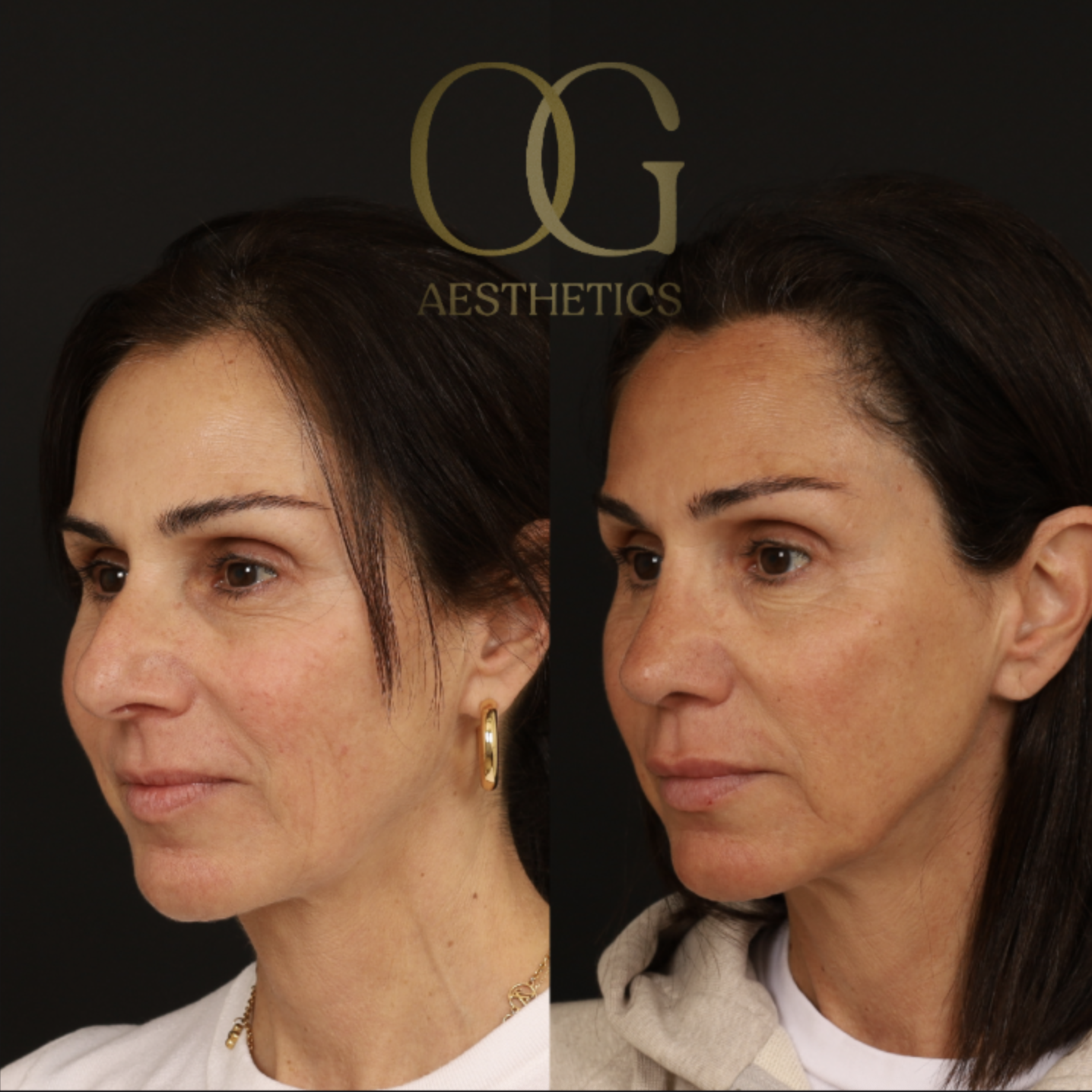 Rhinoplasty Before & After Gallery - Patient 395442 - Image 4