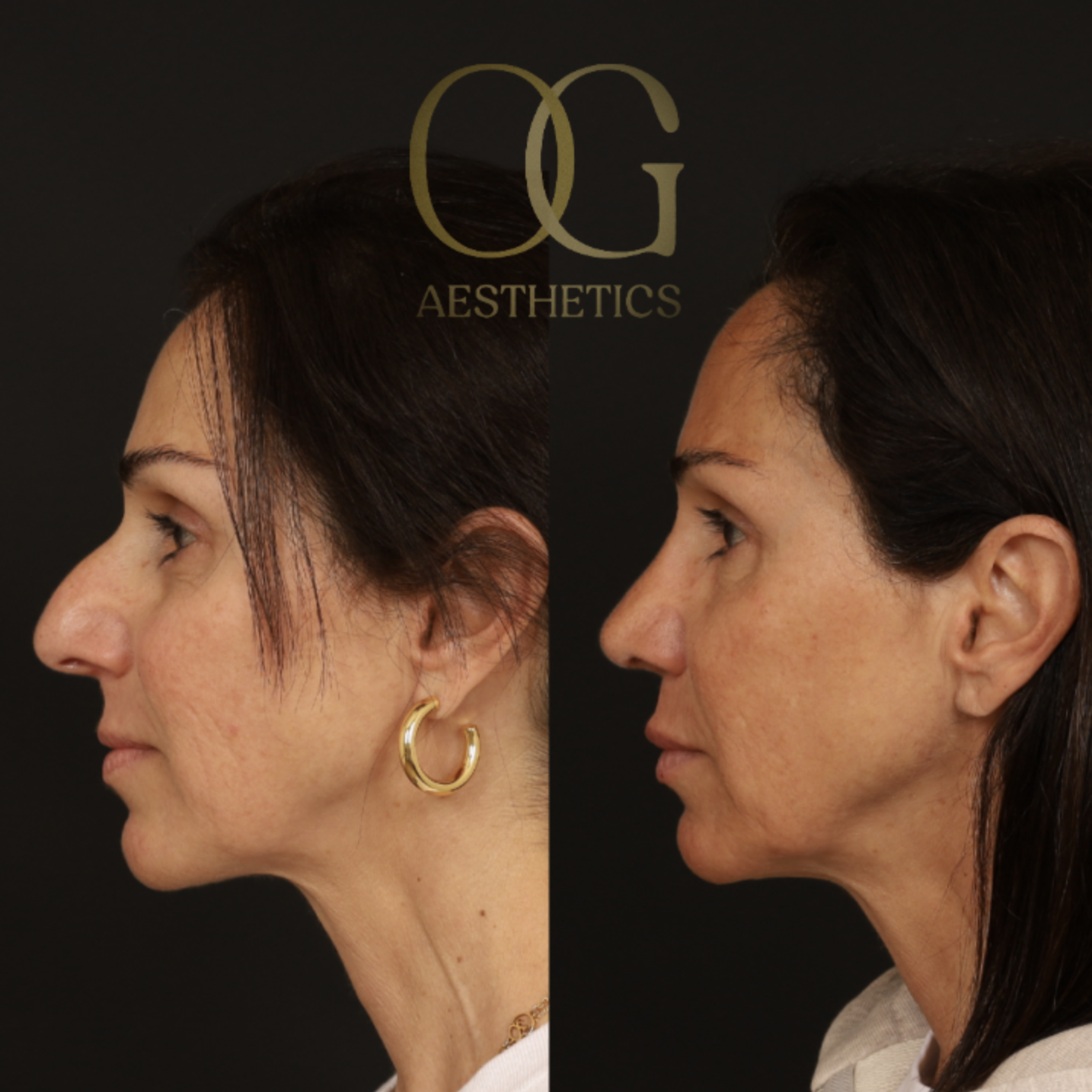 Rhinoplasty Before & After Gallery - Patient 395442 - Image 5