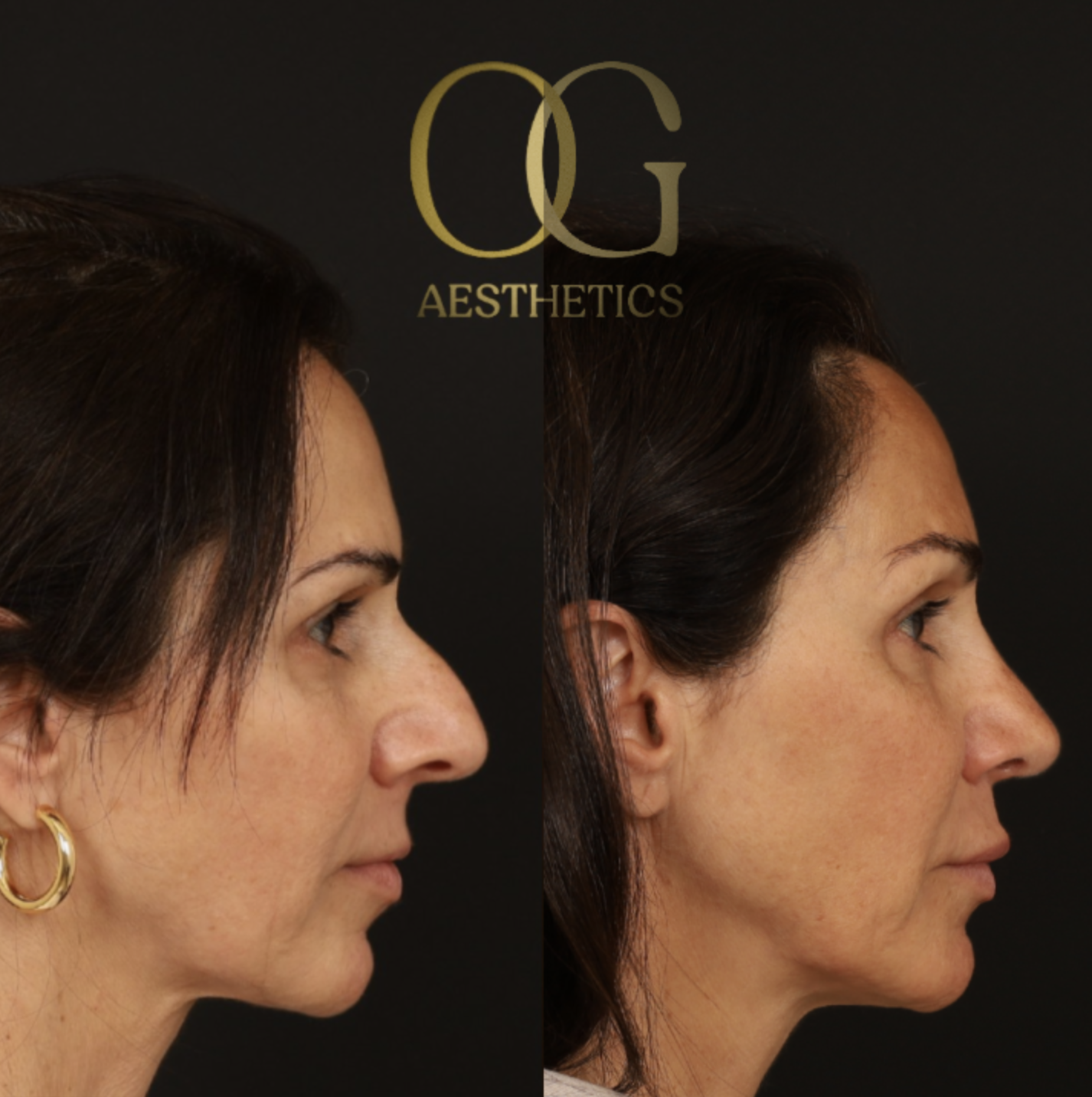 Rhinoplasty Before & After Gallery - Patient 395442 - Image 3