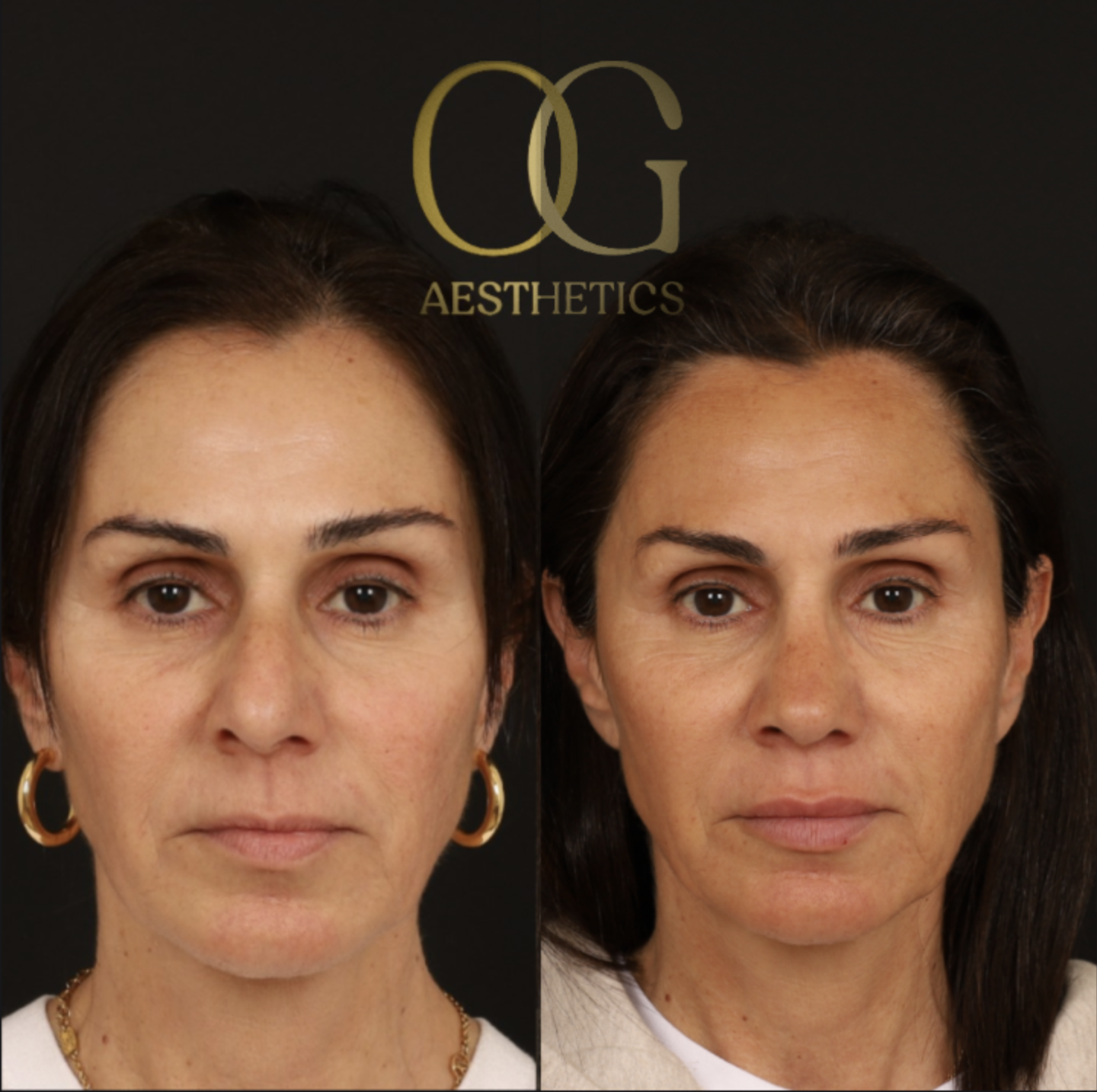 Rhinoplasty Before & After Gallery - Patient 395442 - Image 1