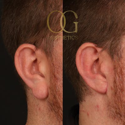 Otoplasty Before & After Gallery - Patient 165272 - Image 1