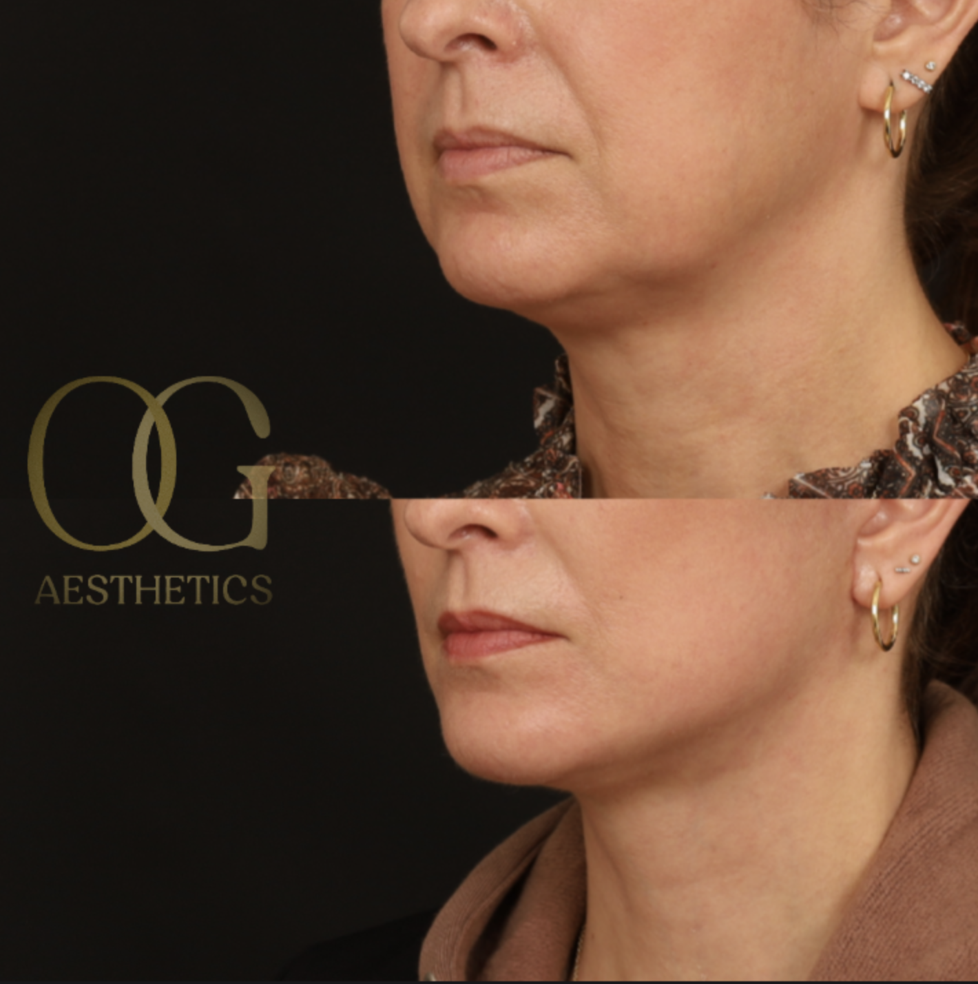 Facelift Before & After Gallery - Patient 281070 - Image 4