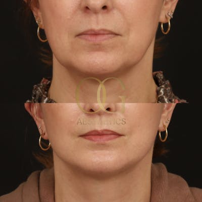 Neck Lift Before & After Gallery - Patient 416625 - Image 1