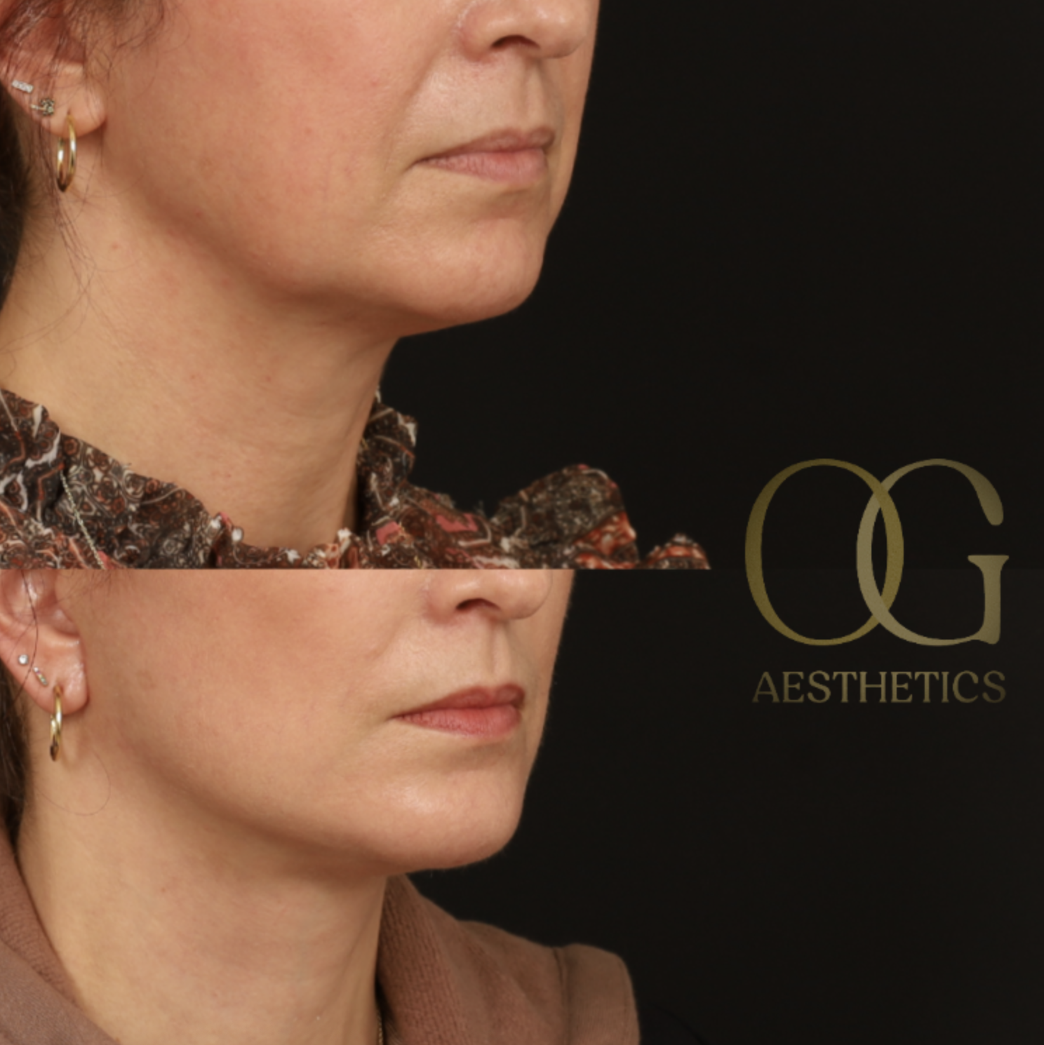 Facelift Before & After Gallery - Patient 281070 - Image 2