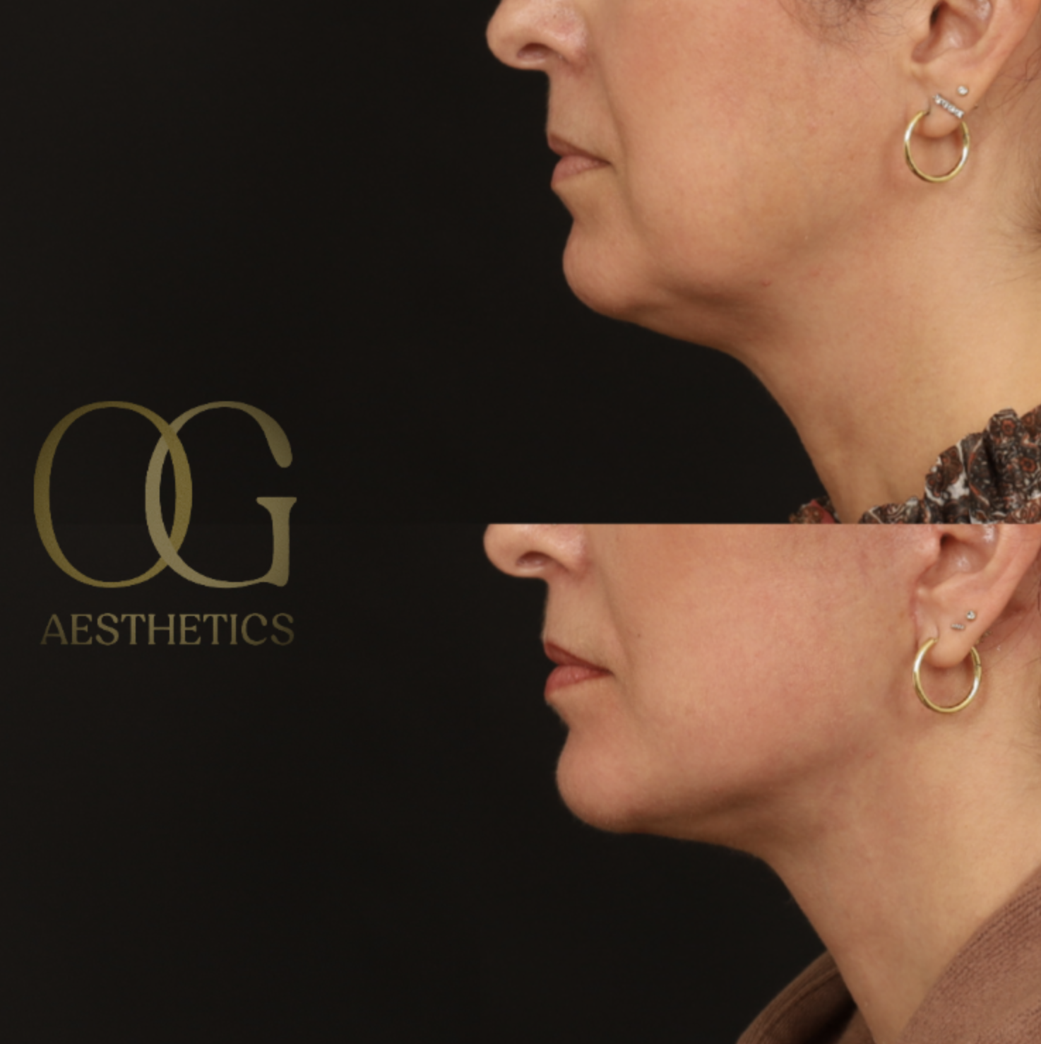 Facelift Before & After Gallery - Patient 281070 - Image 5