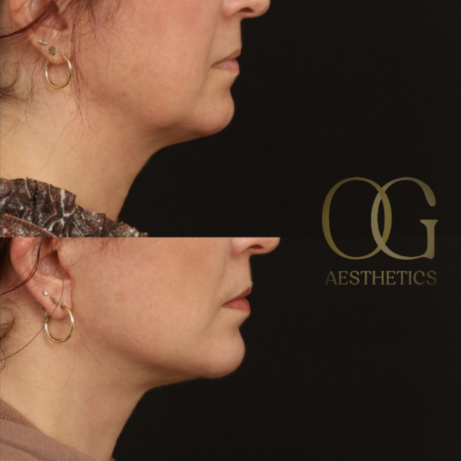 Facelift Before & After Gallery - Patient 281070 - Image 3