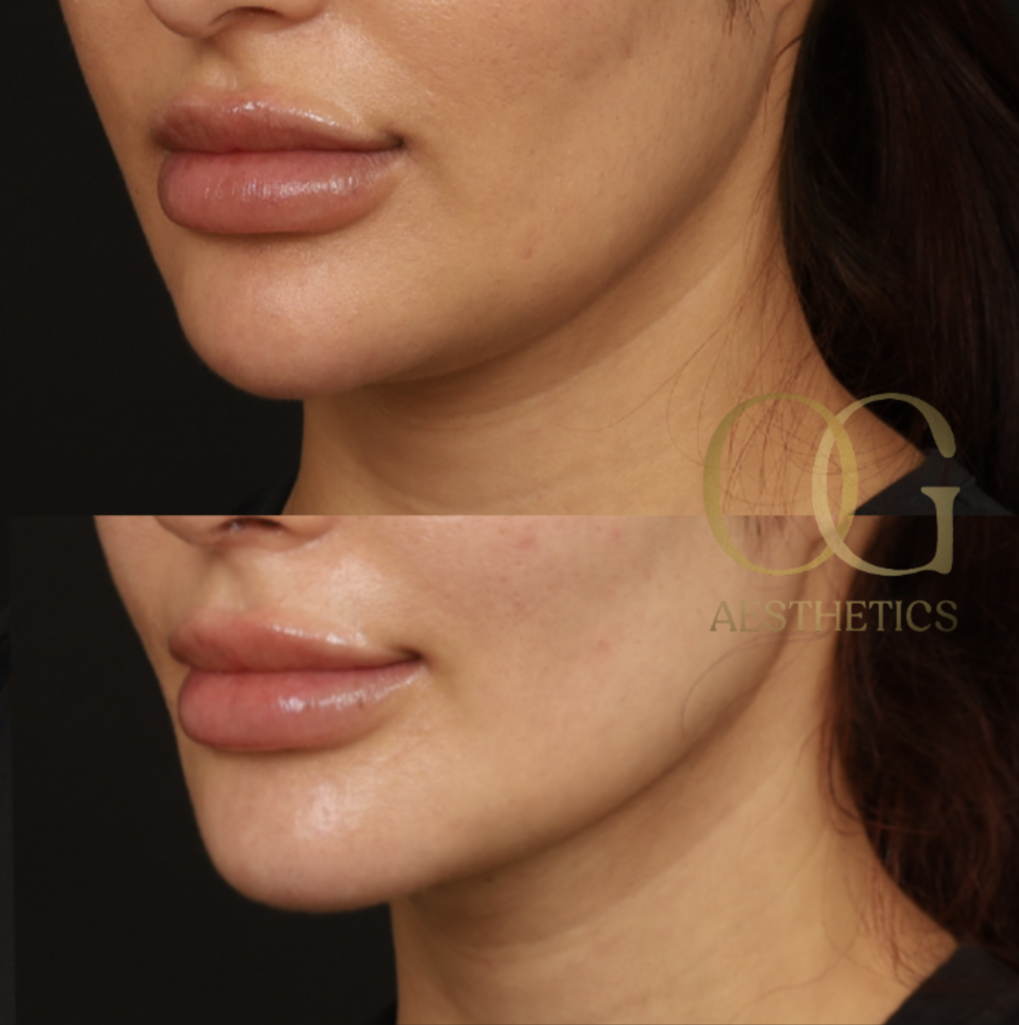 Chin Augmentation Before & After Gallery - Patient 164468 - Image 5