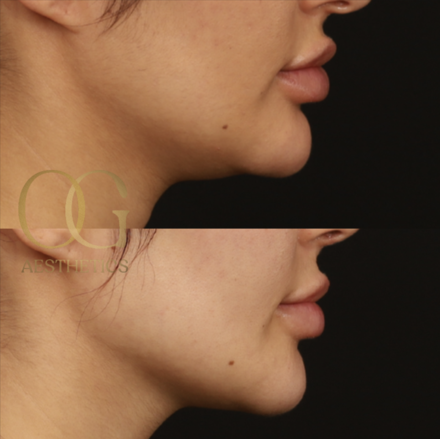 Chin Augmentation Before & After Gallery - Patient 164468 - Image 1