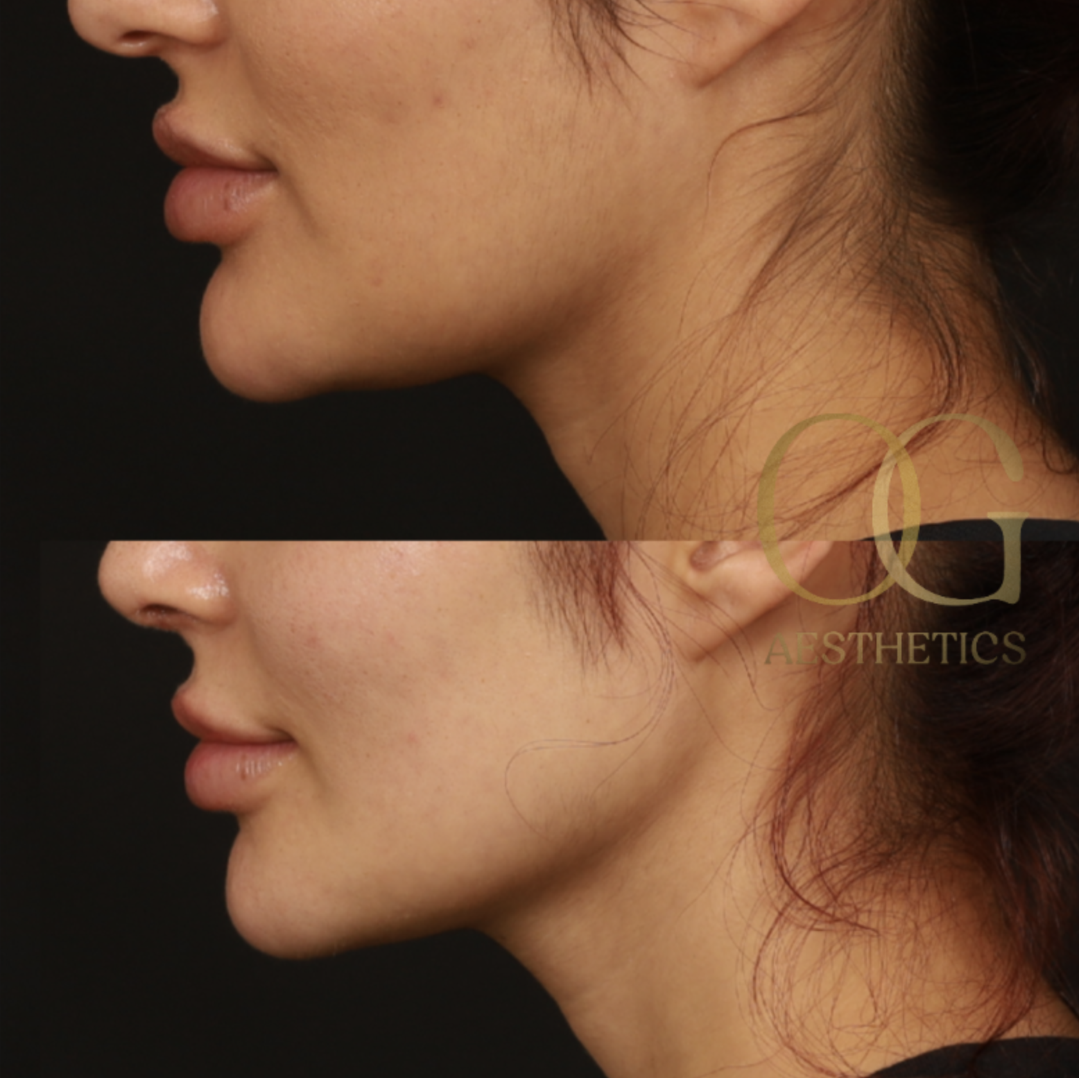 Chin Augmentation Before & After Gallery - Patient 164468 - Image 4