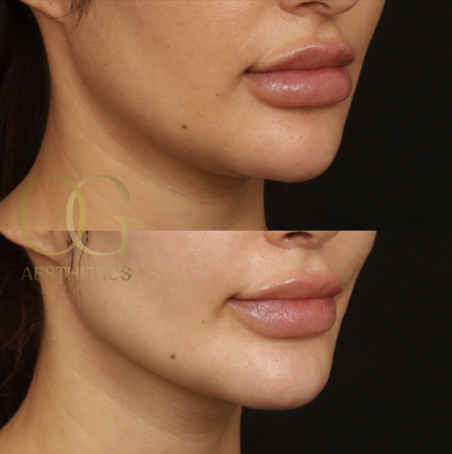 Chin Augmentation Before & After Gallery - Patient 164468 - Image 2